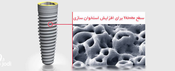 بررسی عوامل موثر قیمت ایمپلنت دندان در سال ۱۴۰۳