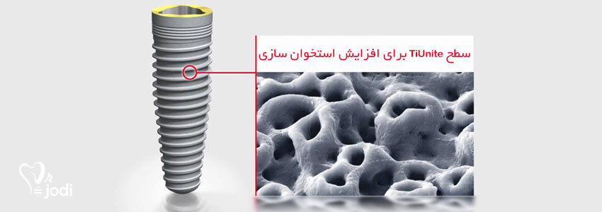 بررسی عوامل موثر قیمت ایمپلنت دندان در سال ۱۴۰۳