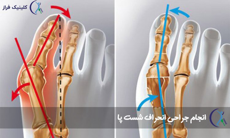 جراحی انحراف شست پا