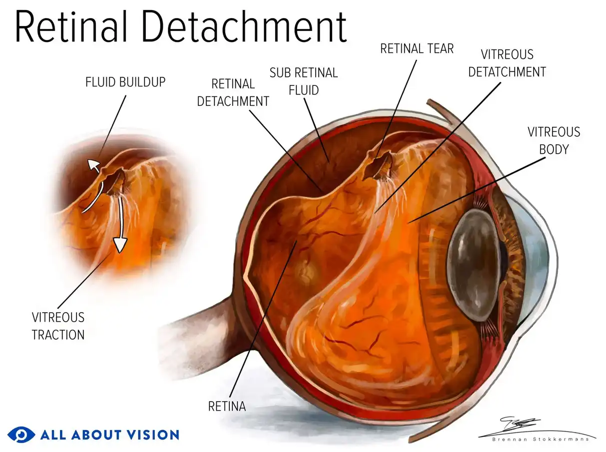 چیزهای ضروری که باید در مورد بیماری جداشدگی شبکیه چشم بدانید | بازیگرها
