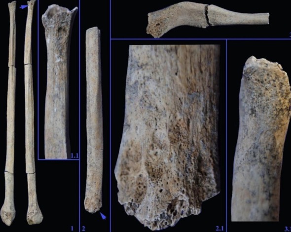 چگونه یک مرد جوان 6000 سال پیش از حمله شیر جان سالم به در برد؟ | یک دکتر 2 1765026628 519 چگونه یک مرد جوان 6000 سال پیش از حمله شیر