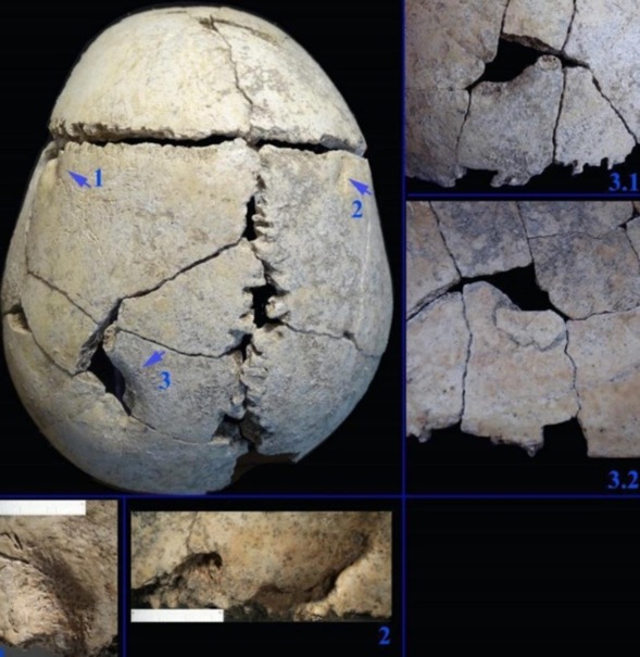 چگونه یک مرد جوان ۶۰۰۰ سال پیش از حمله شیر جان سالم به در برد؟ | یک دکتر چگونه یک مرد جوان ۶۰۰۰ سال پیش از حمله شیر جان سالم به در برد؟ | یک دکتر