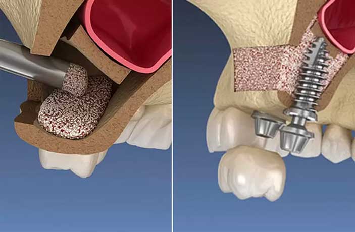 تفاوت لیفت سینوس باز و بسته توسط پزشک 2 جراحی سینوس لیفت باز