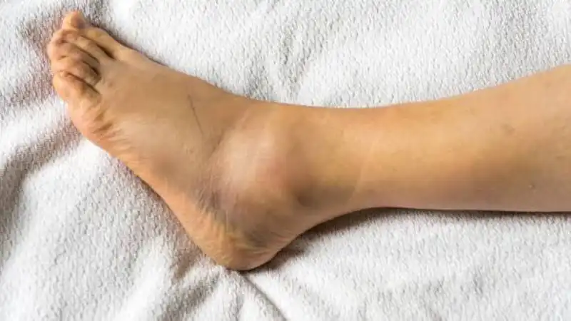 7 علت متداول تورم بدون درد مچ پا، زمان ویزیت و روش درمان 2 تورم پا