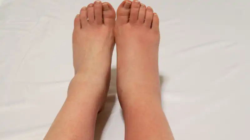 ۷ علت متداول تورم بدون درد مچ پا، زمان ویزیت و روش درمان ۷ علت متداول تورم بدون درد مچ پا، زمان ویزیت و روش درمان