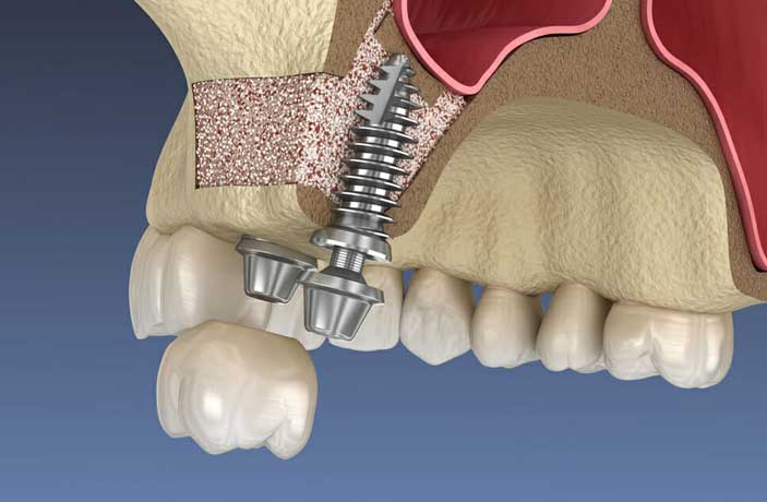 تفاوت لیفت سینوس باز و بسته توسط پزشک تفاوت لیفت سینوس باز و بسته توسط پزشک