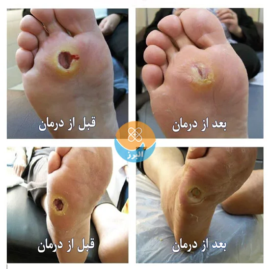 با مراجعه به کلینیک زخم پزشک از قطع عضو جلوگیری کنید. با مراجعه به کلینیک زخم پزشک از قطع عضو جلوگیری کنید.